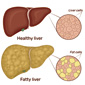 From Alcohol to Sugar: The Surging Epidemic of Fatty Liver Disease