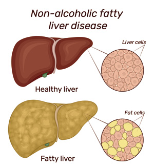 Non Alcoholic Fatty Liver Disease