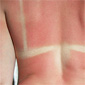 Understanding the Differences Between Heat Rash, Sunstroke, and Sun Poisoning