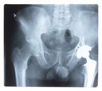 Hip Replacement Surgery