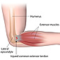 Tennis and Golfers Elbow - Strategies to fight the pain.