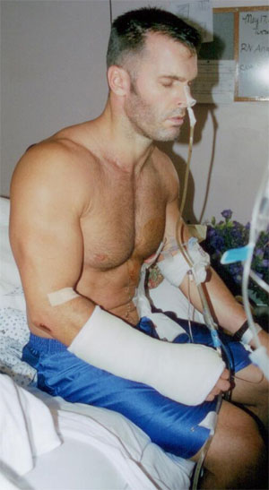 Exercise prevents muscle loss for broken bones.