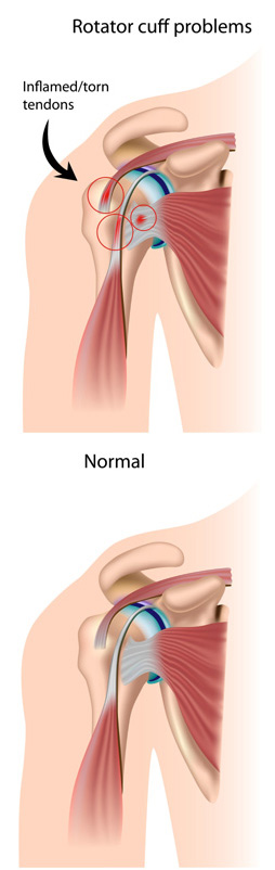 Rotator Cuff Injuries