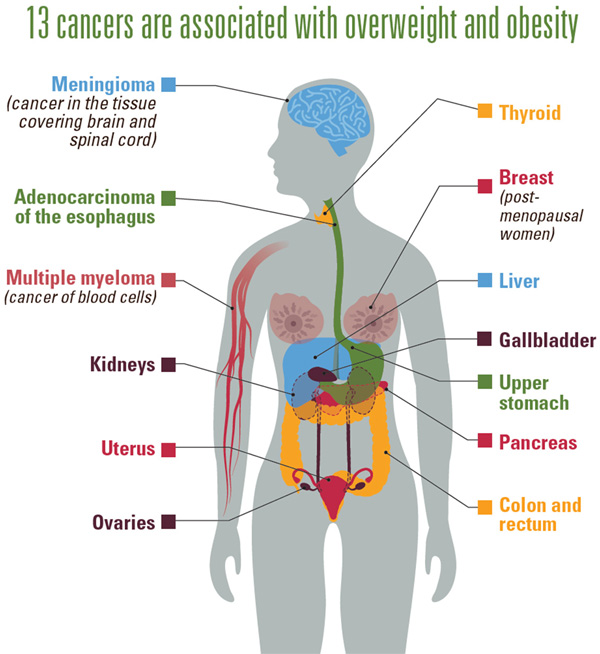 13 Cancers Associated with Obesity