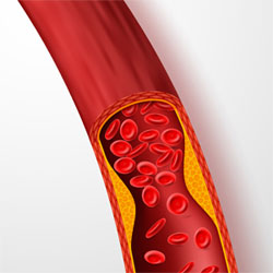 Plaque building up in a blood vessel.